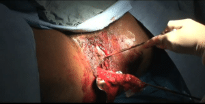 Abortamento 030