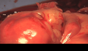 Abortamento 038